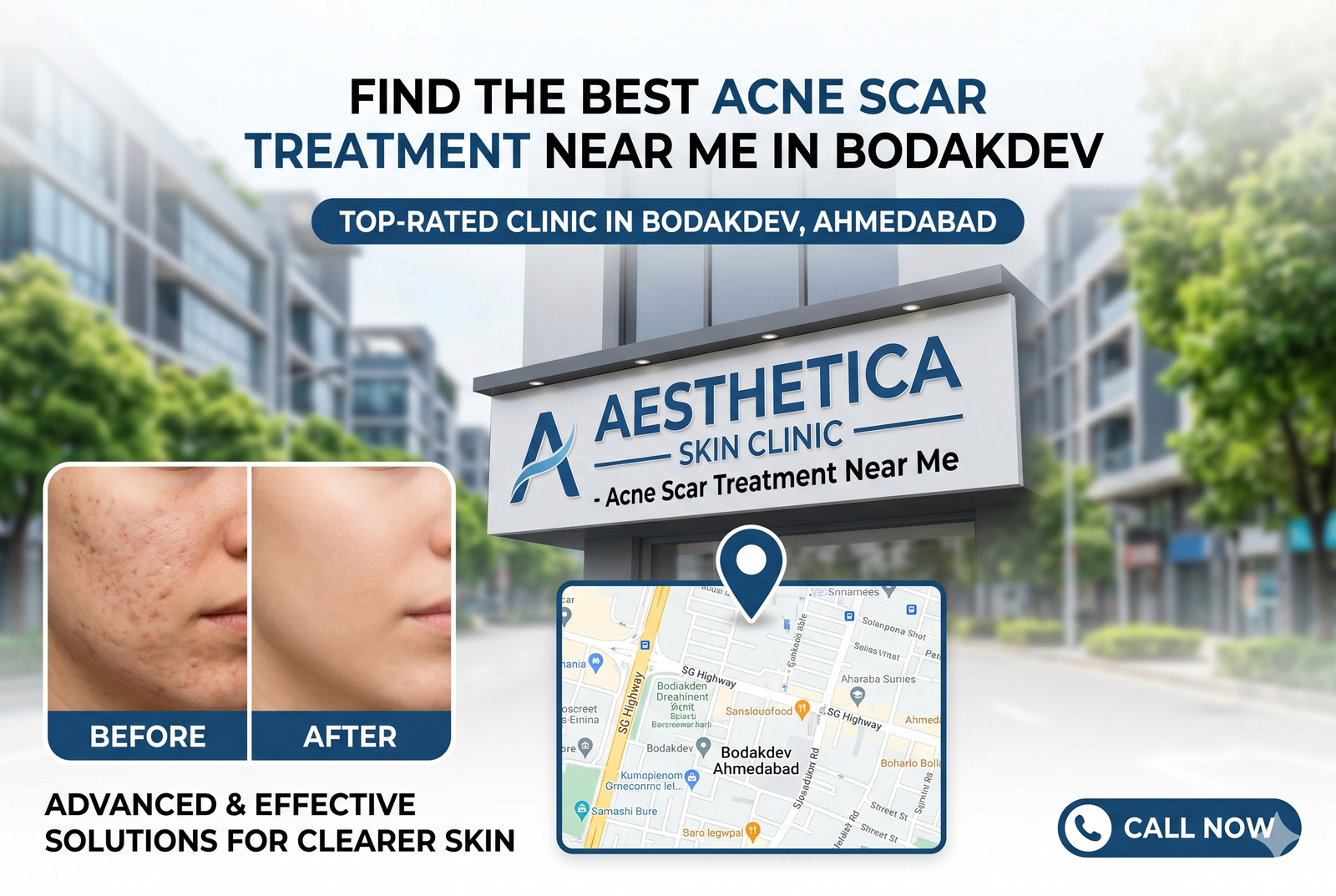 Acne Scar Treatment Near Me in Bodakdev, Ahmedabad