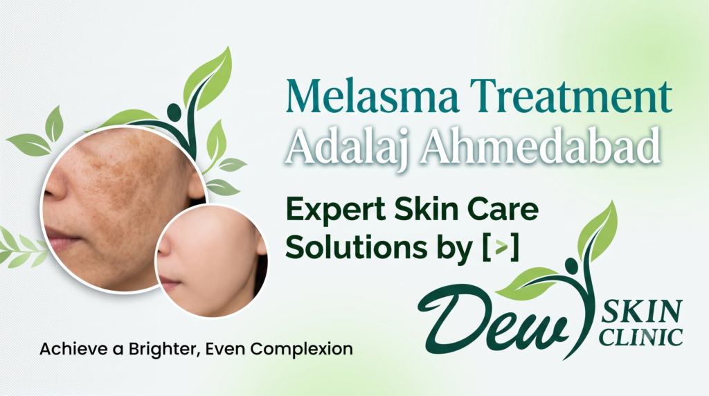 Melasma Treatment in Adalaj Ahmedabad: A Complete Dermatologist Guide