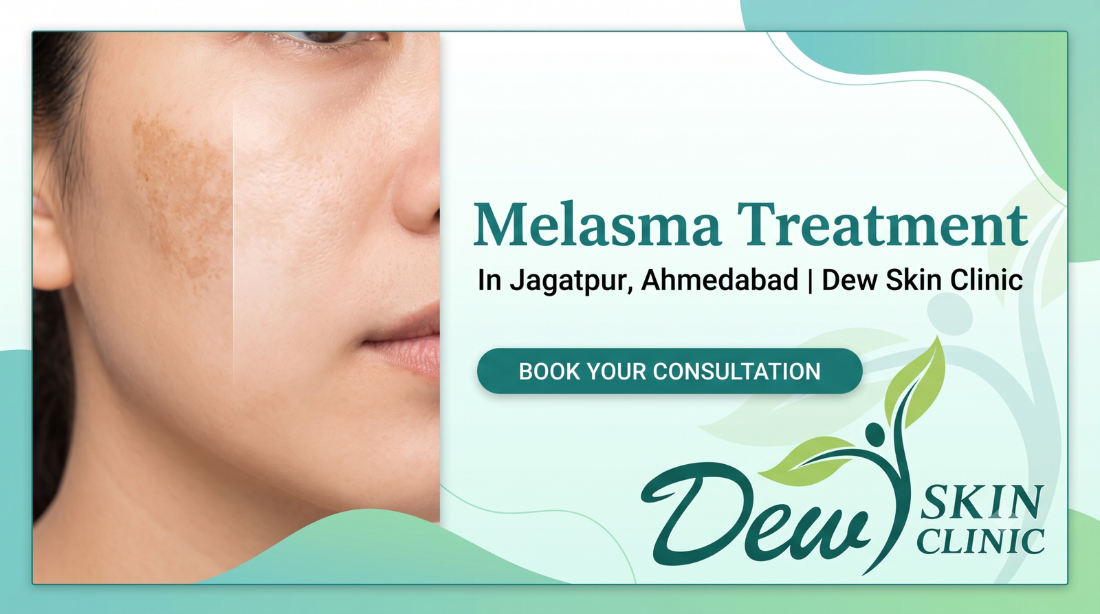 Melasma Treatment in Jagatpur, Ahmedabad: A Complete Dermatologist Guide to Clearing Dark Patches